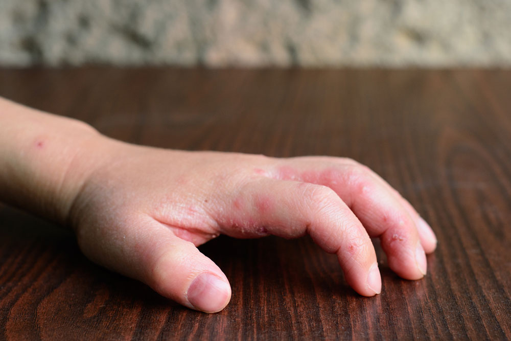 8 first-line treatment options for atopic dermatitis in infants